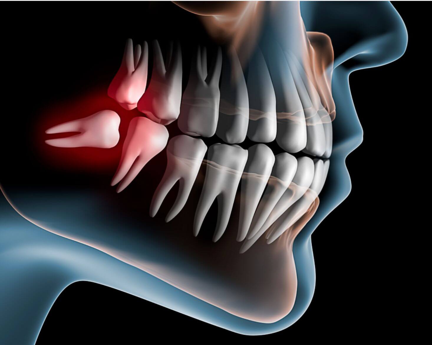 Extração de dente do siso
